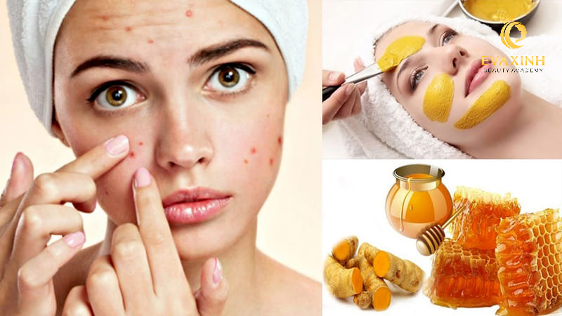 cách điều trị mụn cách điều trị mụn
