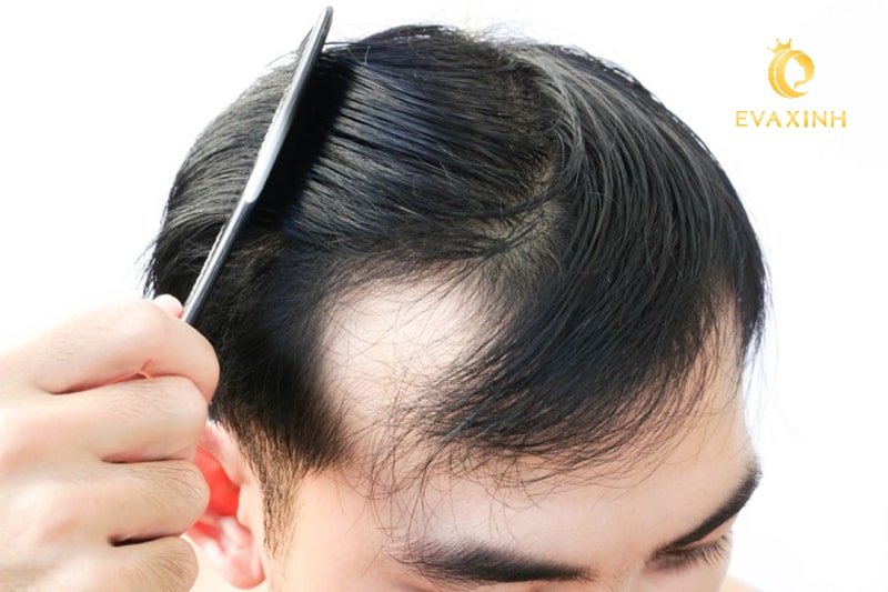 Xăm tóc cho người hói đầu có thực sự đem lại hiệu quả