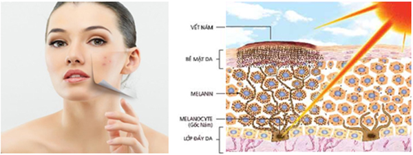 Điều trị nám công nghệ cao bằng phương pháp tái sinh đa tầng tại Eva Xinh