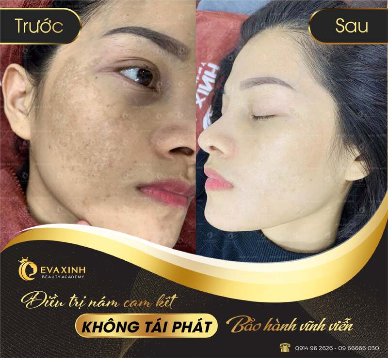 Điều trị nám công nghệ cao bằng phương pháp tái sinh đa tầng tại Eva Xinh